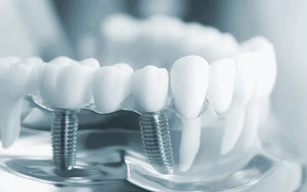 Phục hình Toàn sứ Implant