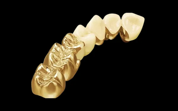 Răng sứ Quý kim