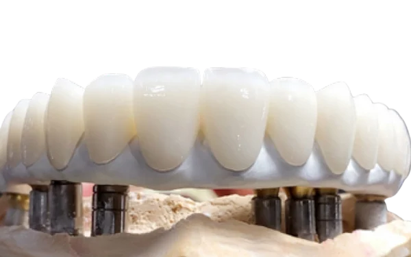 Hybrid sứ Titanium